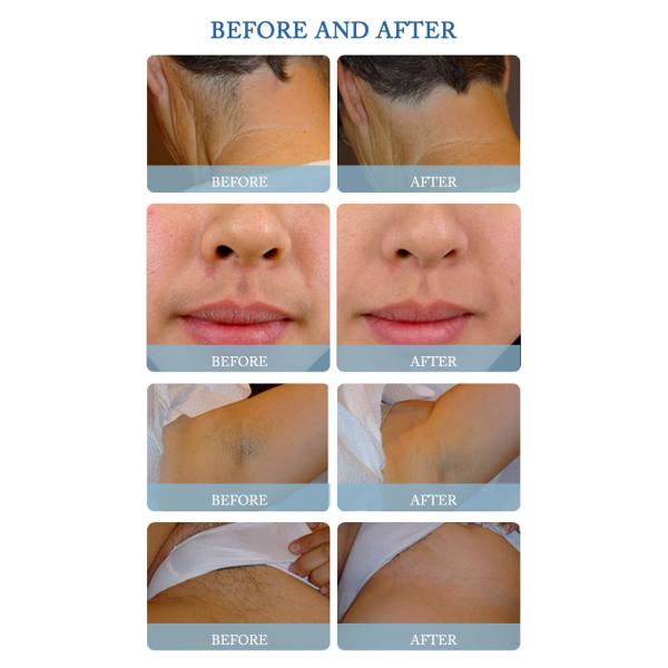 Newest Vertical diode laser hair removal 808nm / removal facial hair 808nm diode laser hair removal machine LF-647b