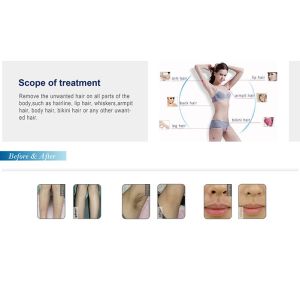 808nm Diode Laser Hair Removal Equipment For Permanent Hair Removal