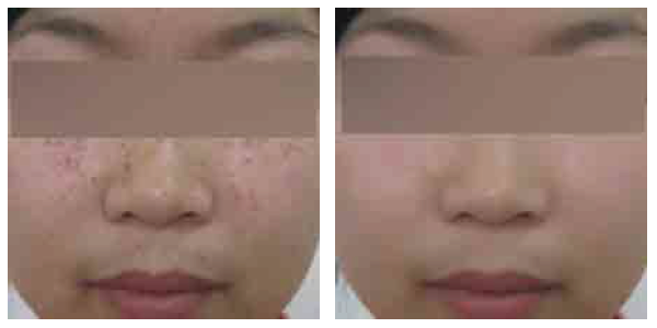 Q Switched Nd YAG Laser Pigmentation Removal Machine , YAG Laser Tattoo Removal Machine