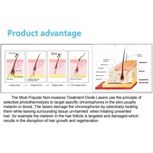 Fast and Efficient Diode Laser Hair Removal Machine for Men and Women 1