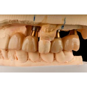 Self Tapping 3.0mm Thread Dental Titanium Implant Optimized Functionality