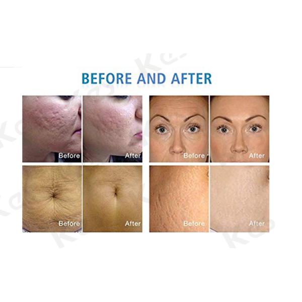 Portable 2MHz 10w Radio Frequency Microneedling Machine