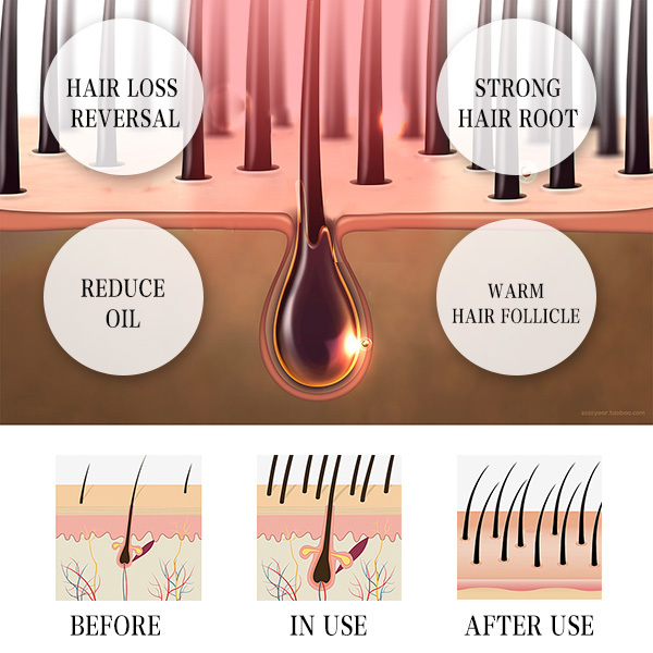 Laser Hair Growth Machine in use