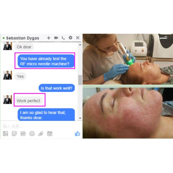 Scars and Ance removal / wrinkle removal/ /face lifting/ Skin rejuvenation