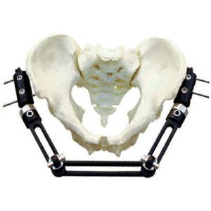 Pelvic Fracture Orthopedic External Fixator Implant Materials For Trauma