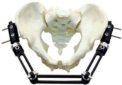 Buy Surgical Orthopedic External Fixator T Type For Pelvic Fractures at wholesale prices