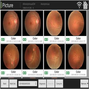 FDA Digital Retinal Camera Observing Macular Degeneration And Bleeding