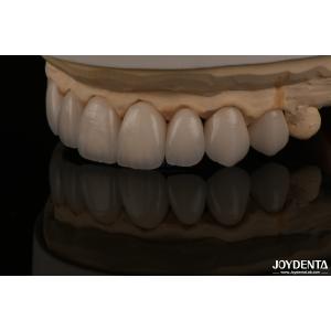 Feldspathic Natural Looking Cosmetic Veneers Precise Fit Highly Translucent