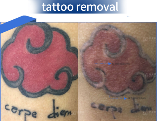 600ps Pulse Width 400mj Picosecond Laser Machine For Pigmentation 2