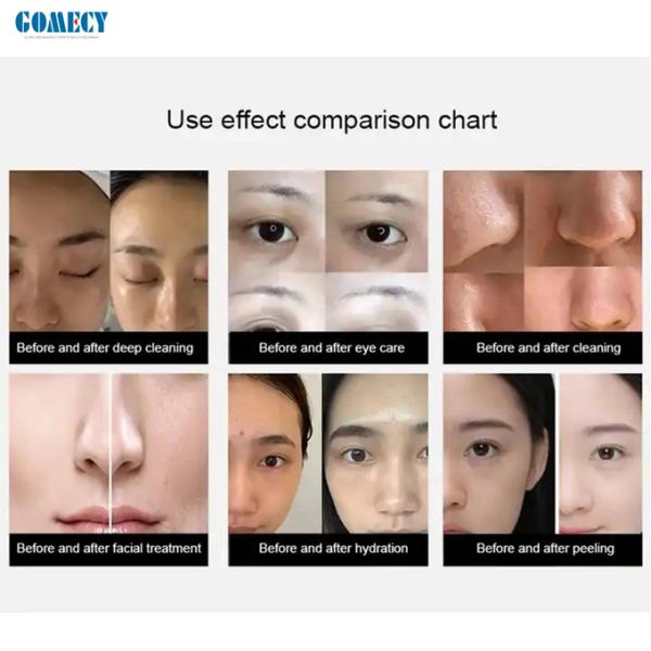 14 In 1 Oxygen Jet Peel Machine 300W Hydro Dermabrasion Facial Machine