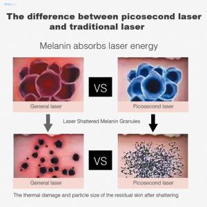 Nd Yag Picosecond Laser Tattoo Removal Machine Adjustable And Safety