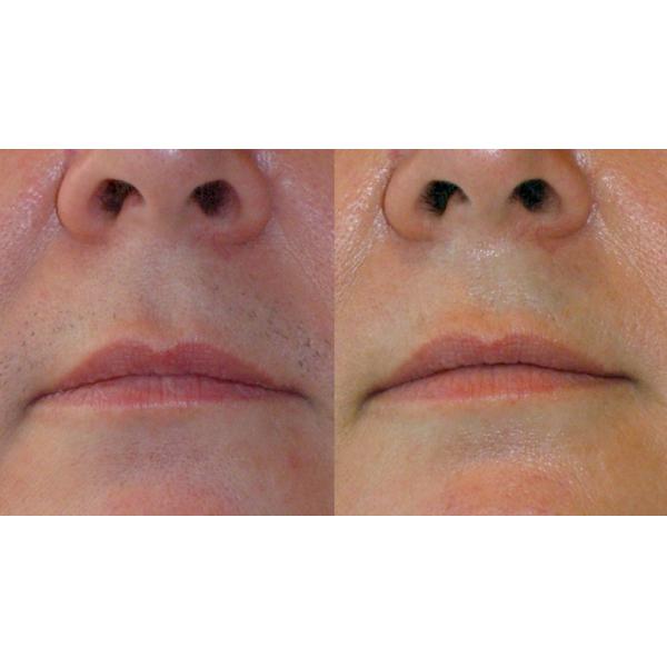 2014 Newest hair removal laser diode/diode laser hair removal