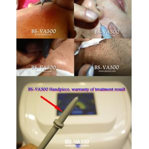 Vein Vascular removal High frequency vascular removal beauty machine coagulation