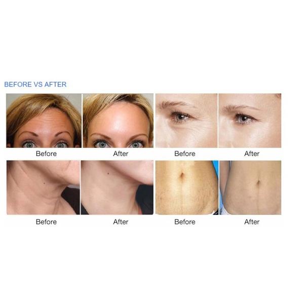 monopolar rf removal forehead wrinkles Thermolift Device Rf Skin Tightening Machine