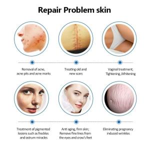 Co2 Laser Machine Laser Co2 Fractional Skin Resurfacing Machine