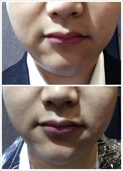 Beautiful Design High Quality Manufacturer Direct Sale Portable Cryolipolysis Machine For