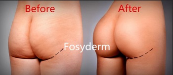 20ml Dermal Fillers For Buttocks Hyaluronic Acid Dermal Filler Hydrogel Injections