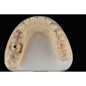 titanium 10mm Single Tooth Dental Implants Replacement Abutment Self Tapping