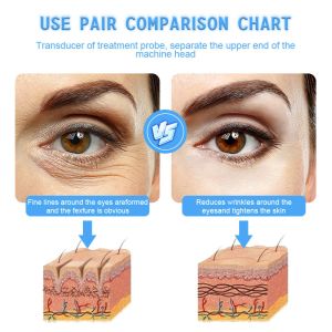 Radiofrecuencia Fractional RF Microneedling Machine with 2 Handles