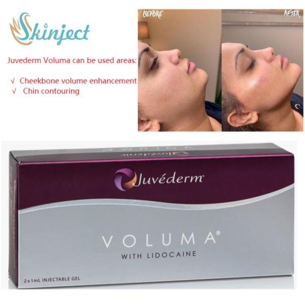 Buy Dermal Juvederm Voluma Filler Hyaluronic Acid For Facial Contour at wholesale prices