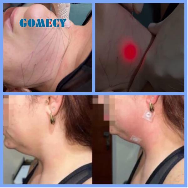 Buy Endolift Laser Machine for Spider Veins/face Veins Removal and Lipolysis/Liposuction Fat Melting Pulse Duration 0-999s at wholesale prices