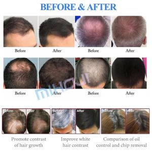 5 In 1 PDT LED Light Laser Hair Growth Machine With 650nm Laser Wave