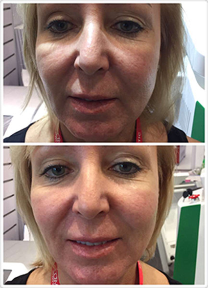 Beautiful Design High Quality Manufacturer Direct Sale Portable Cryolipolysis Machine For