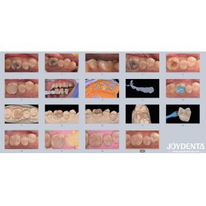 Quality Adults Children Porcelain Ceramic Dental Inlay Restorative for Damaged Teeth for sale