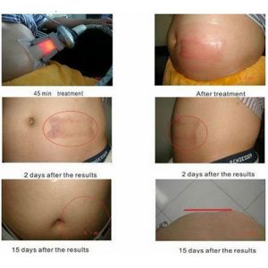 2 handles Zeltiq Fat freezing Cryolipolysis body slimming machine