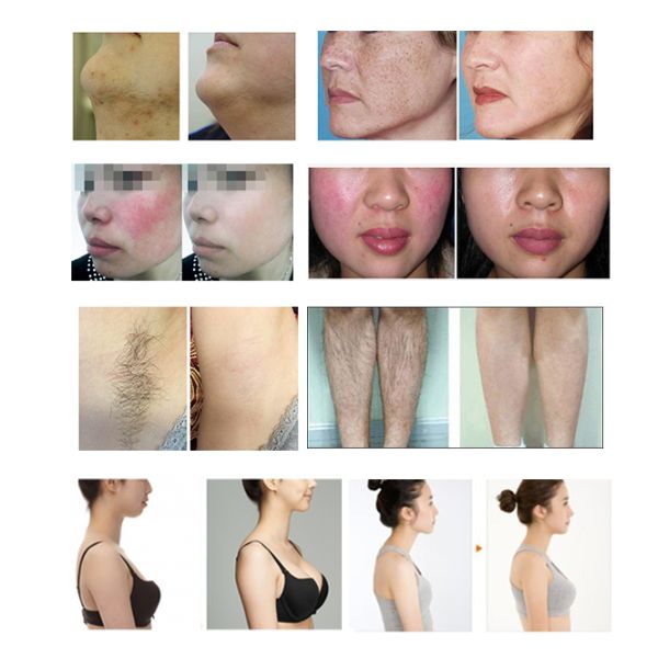 220V / 110V SHR IPL RF Beauty Equipment For Skin Rejuvenation Acne Therapy