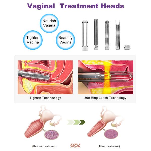 ZGV13-02 Fractional CO2 RF Tube laser machine Private Laser black color salon beauty machine