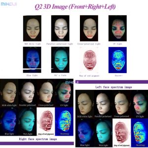 Effective Acne Treatment with Q1 Q2 Skin Analysis Machine and Pigmentation