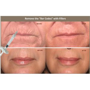 China 10ml Injectable Hyaluronic Acid Dermal Filler For Correcting Facial Asymmetry on sale