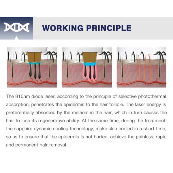 Long pulse q switch 755 1064 nd yag alexandrite laser hair removal machine price