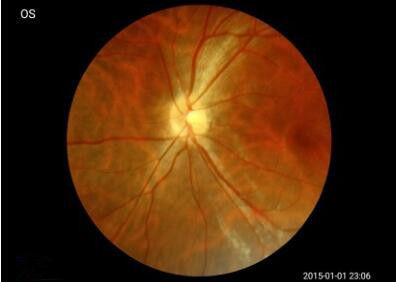 Android System For Easier Operation Hand-held Fundus Camera With Minimum Pupil 2.5mm Image Resolution 1920x1080