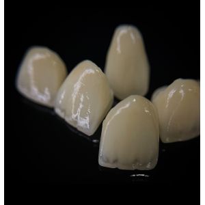 Comfortable Zirconia Crown With Good Fitting And Precision Esthetics