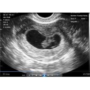 Transvaginal Endocavity Portable Pregnancy Scanner For OB / GYN Portable