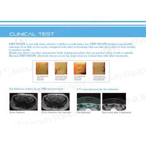 Beijing hifu slimming machine best non-invasive technology worldwide