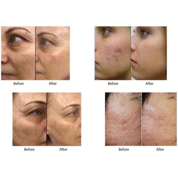 Safe And Precise Fractional RF Microneedling Machine For Skin Rejuvenation And Tightening