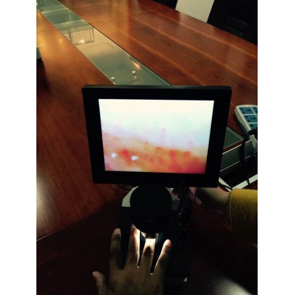 Hospital Microcirculation Microscope Nailfold Video Capillaroscope Detection