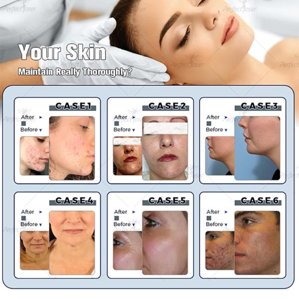 13 In 1 Hydrafacial Beauty Machine Diamond Microdermabrasion Aqua Peel Shrink Pores
