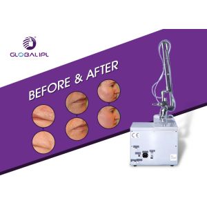 Pigmentation Removal CO2 Fractional Laser Machine For Skin Resurfacing 25W