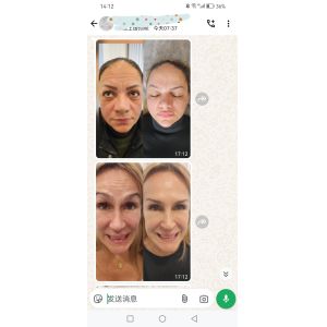 Cosmetic Dysport 500 Units Botulinum Toxin 500 IU Powder For Injection