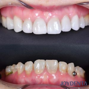 Porcelain Veneer Oral Restoration