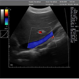 Portable Color Doppler Ultrasound Machine With Measurements And Calculations