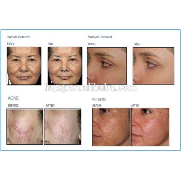 Globalipl 2018 Professional CE Approved Fractional CO2 Laser Acne Treatment Machine/Acne Laser