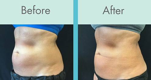 Multifunction Body Sculpture 10.4" Cryolipolysis Equipment