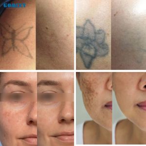 6 Optional Heads Carbon Peeling Picosecond Laser Treatment Skin Rejuvenation