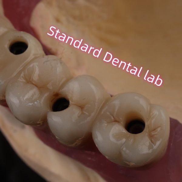Fast Cement and Save Time Implant Products Dental Zirconia Crowns Bridge