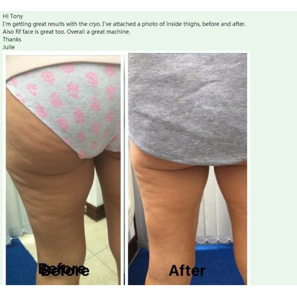 Beautiful Design High Quality Manufacturer Direct Sale Portable Cryolipolysis Machine For